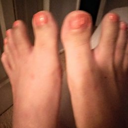 Bruised feet post "spa pedicure", ruined nail polish