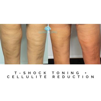 Cloud9Cryo - Progress: 2 Cellulite Reduction + 1 Toning. - Cryotherapy Near Me - Long Beach, California