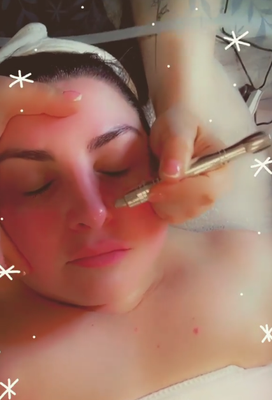 Microdermabrasion - Microdermabrasion is a minimally invasive procedure used to renew overall skin tone and texture. It can improve the appearance of sun damage, wrinkles, fine lines, age spots, acne scarring, melasma, and other skin-related concerns and conditions.