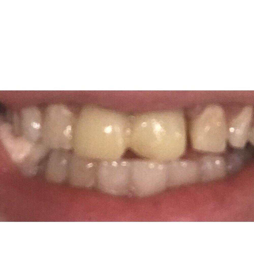 Eric George, DMD & Associates - MY teeth AFTER being seen at this office. An absolute mess. The front yellow "thing" is the temp crowns they sent me home with - General Dentistry Near Me - Coventry, Rhode Island Eric George, DMD & Associates - MY teeth AFTER being seen at this office. An absolute mess. The front yellow "thing" is the temp crowns they sent me home with - General Dentistry Near Me - Coventry, Rhode Island