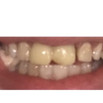 Eric George, DMD & Associates - MY teeth AFTER being seen at this office. An absolute mess. The front yellow "thing" is the temp crowns they sent me home with - General Dentistry Near Me - Coventry, Rhode Island Eric George, DMD & Associates - MY teeth AFTER being seen at this office. An absolute mess. The front yellow "thing" is the temp crowns they sent me home with - General Dentistry Near Me - Coventry, Rhode Island