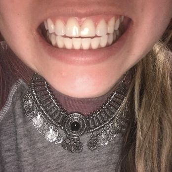 Personalized Orthodontics - Before extractions and braces - Orthodontists Near Me - Sparks, Nevada