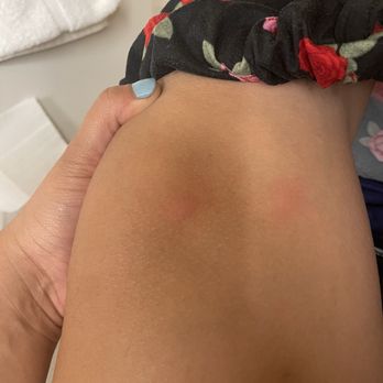 Hampton Inn Denver-Northwest/Westminster - Bed bug bites - Hotels Near Me - Westminster, Colorado Hampton Inn Denver-Northwest/Westminster - Bed bug bites - Hotels Near Me - Westminster, Colorado