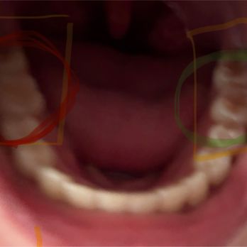 Risas Dental and Braces - Desert Sky - back molar comparison , red side molar is pushed to an angle. look at my teeth from R-L - Orthodontists Near Me - Phoenix, Arizona Risas Dental and Braces - Desert Sky - back molar comparison , red side molar is pushed to an angle. look at my teeth from R-L - Orthodontists Near Me - Phoenix, Arizona