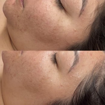 Ready Set Glow - Lactic Peel (no peeling peel) - Eyelash Service Near Me - San Diego, California Ready Set Glow - Lactic Peel (no peeling peel) - Eyelash Service Near Me - San Diego, California