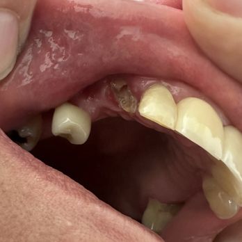 Dentist Williamsburg- James A. Burden, D.D.S. & Associates - Broken tooth - Cosmetic Dentists Near Me - Williamsburg, Virginia Dentist Williamsburg- James A. Burden, D.D.S. & Associates - Broken tooth - Cosmetic Dentists Near Me - Williamsburg, Virginia