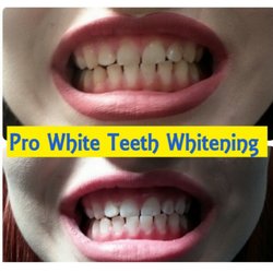 Prowhite Teeth Whitening - Before and after teeth whitening sessions.