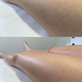Allure Waxing Studio - Full legs before and after - Waxing Near Me - Naples, Florida Allure Waxing Studio - Full legs before and after - Waxing Near Me - Naples, Florida