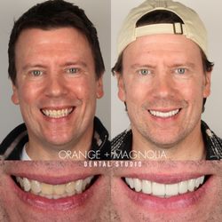 Orange and Magnolia Dental Studio - 10 porcelain veneers smile makeover by Dr. Joyce Kahng, cosmetic dentist in Orange County veneers