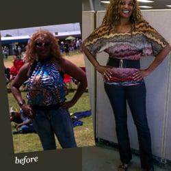 Dallas Bariatric Center - Sleeve Gastrectomy Patient