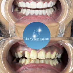 The Veneer Experts - Veneers before and after