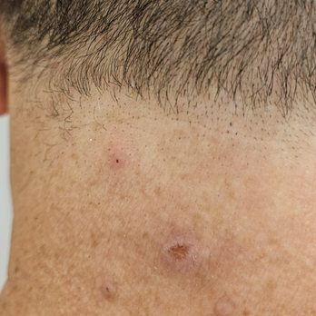 Springdale Barbers - These acne blemishes and pimples are after 2 weeks of healing. Was much worse a couple days after the haircut. - Barbers Near Me - Huntington Beach, California Springdale Barbers - These acne blemishes and pimples are after 2 weeks of healing. Was much worse a couple days after the haircut. - Barbers Near Me - Huntington Beach, California
