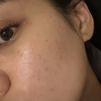 Skin Bar by Mila - After -- no makeup - Skin Care Near Me - Long Beach, California Skin Bar by Mila - After -- no makeup - Skin Care Near Me - Long Beach, California