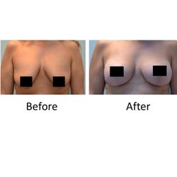 Denton Plastic Surgery - This patient received a breast augmentation with a breast lift.