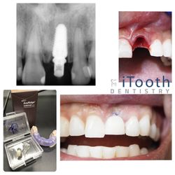 iTooth Dentistry - Immediate anterior implants.