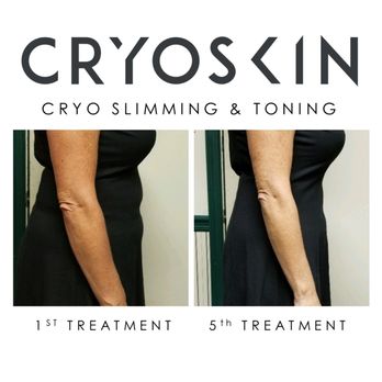 Simply Kneaded Performance Therapy - We guarantee you will lose at least 1/2 inch on your first CryoSkin Slimming session! - Massage Therapy Near Me - Wildomar, California Simply Kneaded Performance Therapy - We guarantee you will lose at least 1/2 inch on your first CryoSkin Slimming session! - Massage Therapy Near Me - Wildomar, California