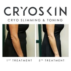 Simply Kneaded Performance Therapy - We guarantee you will lose at least 1/2 inch on your first CryoSkin Slimming session!