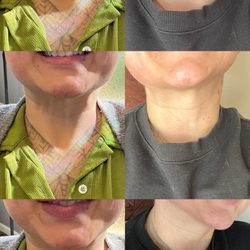 Precision Aesthetics - Neck bands gone!