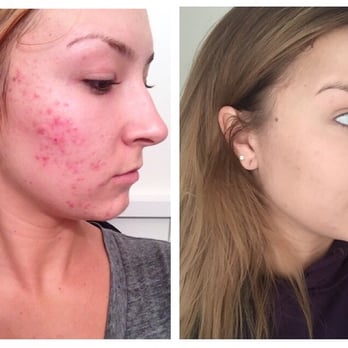 Skincare By Lori - Before and after a year of treatments - Skin Care Near Me - Newport Beach, California Skincare By Lori - Before and after a year of treatments - Skin Care Near Me - Newport Beach, California
