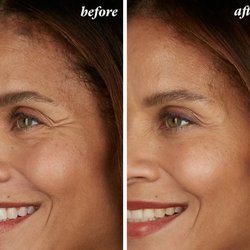 Bella Grey Medical Spa - Before and after photos of a woman who received Botox injections