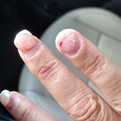 Queen Nails - One ripped completely off. The other shows blood seeping though the nail bed.