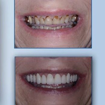Eureka Smiles - Before and after!! - General Dentistry Near Me - Eureka, Missouri