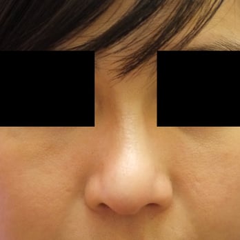 Cheng Plastic Surgery - After surgery (12 months) - Cosmetic Surgeons Near Me - Saratoga, California Cheng Plastic Surgery - After surgery (12 months) - Cosmetic Surgeons Near Me - Saratoga, California