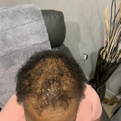 Female hair loss