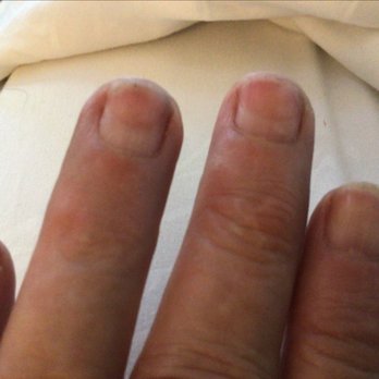Aa Nails Spa - This is the damage they did by removing the gel, they took my nail down to the last layer. It has been a month - Nail Salons Near Me - Boonton, New Jersey Aa Nails Spa - This is the damage they did by removing the gel, they took my nail down to the last layer. It has been a month - Nail Salons Near Me - Boonton, New Jersey