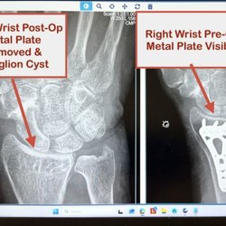 SCOS Orthopedic Specialists - Post-op surgery metal plate removed right wrist. Dr Gautam Malhorta, (Ortho Wrist/Hand Specialist) at SCOS in Laguna Woods, CA.