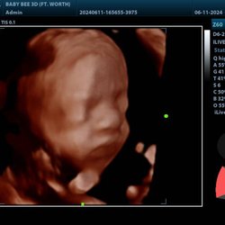 Baby Bee 3D Ultrasound