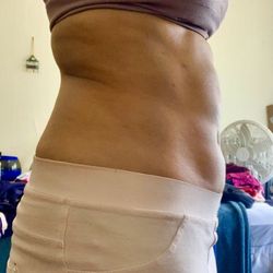 Flawless Image Med Spa - Fat deposits remaining after lipo making my abdomen looking uneven and wavy