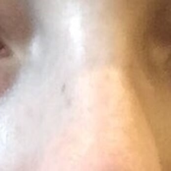 Mitesh Kapadia, MD PhD - Before procedure - very intense lower eye bags - Ophthalmologists Near Me - Wellesley, Massachusetts