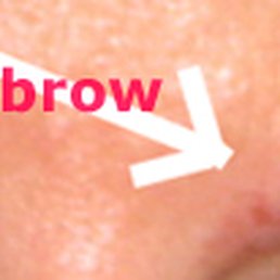 Laser burn and half a missing brow