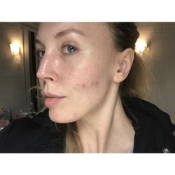 Skin by Stephanie - Before