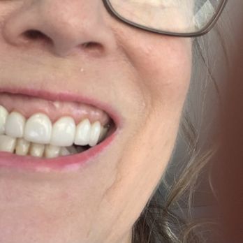 Premier Dental Team - Now I have to pray it doesn't get infected due to the screw being Too Deep. - Cosmetic Dentists Near Me - Gainesville, Florida Premier Dental Team - Now I have to pray it doesn't get infected due to the screw being Too Deep. - Cosmetic Dentists Near Me - Gainesville, Florida