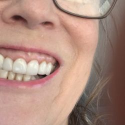 Premier Dental Team - Now I have to pray it doesn't get infected due to the screw being Too Deep.