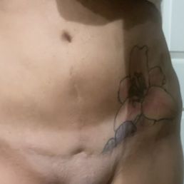 Botched tummy tuck/abdominoplasty by Dr Yegiayants. I am left like this!! Botched tummy tuck/abdominoplasty by Dr Yegiayants. I am left like this!!
