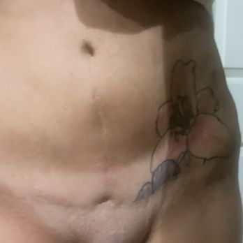 Sara Yegiyants, MD - Botched tummy tuck/abdominoplasty by Dr Yegiayants. I am left like this!! - Medical Spas Near Me - Santa Barbara, California Sara Yegiyants, MD - Botched tummy tuck/abdominoplasty by Dr Yegiayants. I am left like this!! - Medical Spas Near Me - Santa Barbara, California