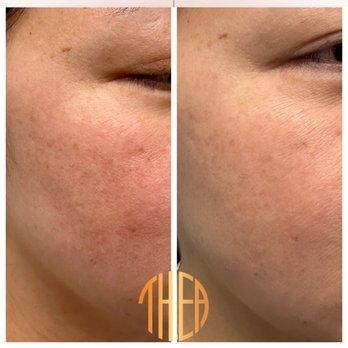 Thea Aesthetic - Microneedling with PRP for skin rejuvenation. - Skin Care Near Me - Tukwila, Washington Thea Aesthetic - Microneedling with PRP for skin rejuvenation. - Skin Care Near Me - Tukwila, Washington