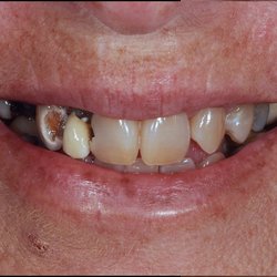 RM Advanced Center For Cosmetic Dentistry - Initial smile with decayed and discolored teeth