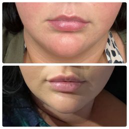 5 days after 1 Syringe.