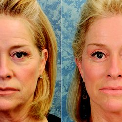 Roberts Cosmetic Surgery - Brow Lift - Face Lift