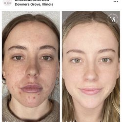 Facecard Medspa - ACNE TREATMENTS BEFORE AND AFTER
