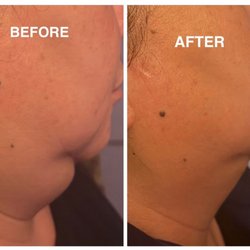 Consistency pays off. Cryotherapy results