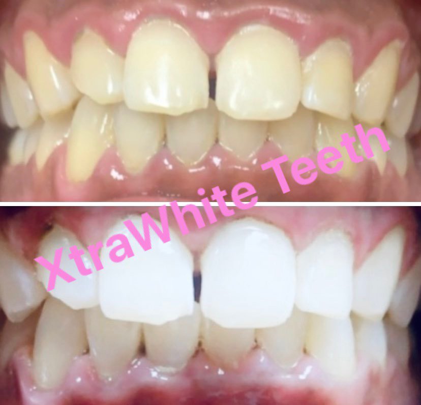 XtraWhite Teeth Logo