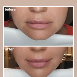 Vesna Aesthetics - Chin Correction