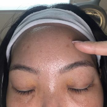 Laser Cliniqúe | San Diego's Premier Medical Spa - Before Acne scar on my forehead even after Fraxel, dynamus and now attempting BBL treatment to remove acne scar - Laser Hair Removal Near Me - San Diego, California Laser Cliniqúe | San Diego's Premier Medical Spa - Before Acne scar on my forehead even after Fraxel, dynamus and now attempting BBL treatment to remove acne scar - Laser Hair Removal Near Me - San Diego, California