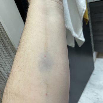 HCA Florida Kendall Hospital - The tech try to fish fir my vein two time on the same vein . - Hospitals Near Me - Miami, Florida HCA Florida Kendall Hospital - The tech try to fish fir my vein two time on the same vein . - Hospitals Near Me - Miami, Florida