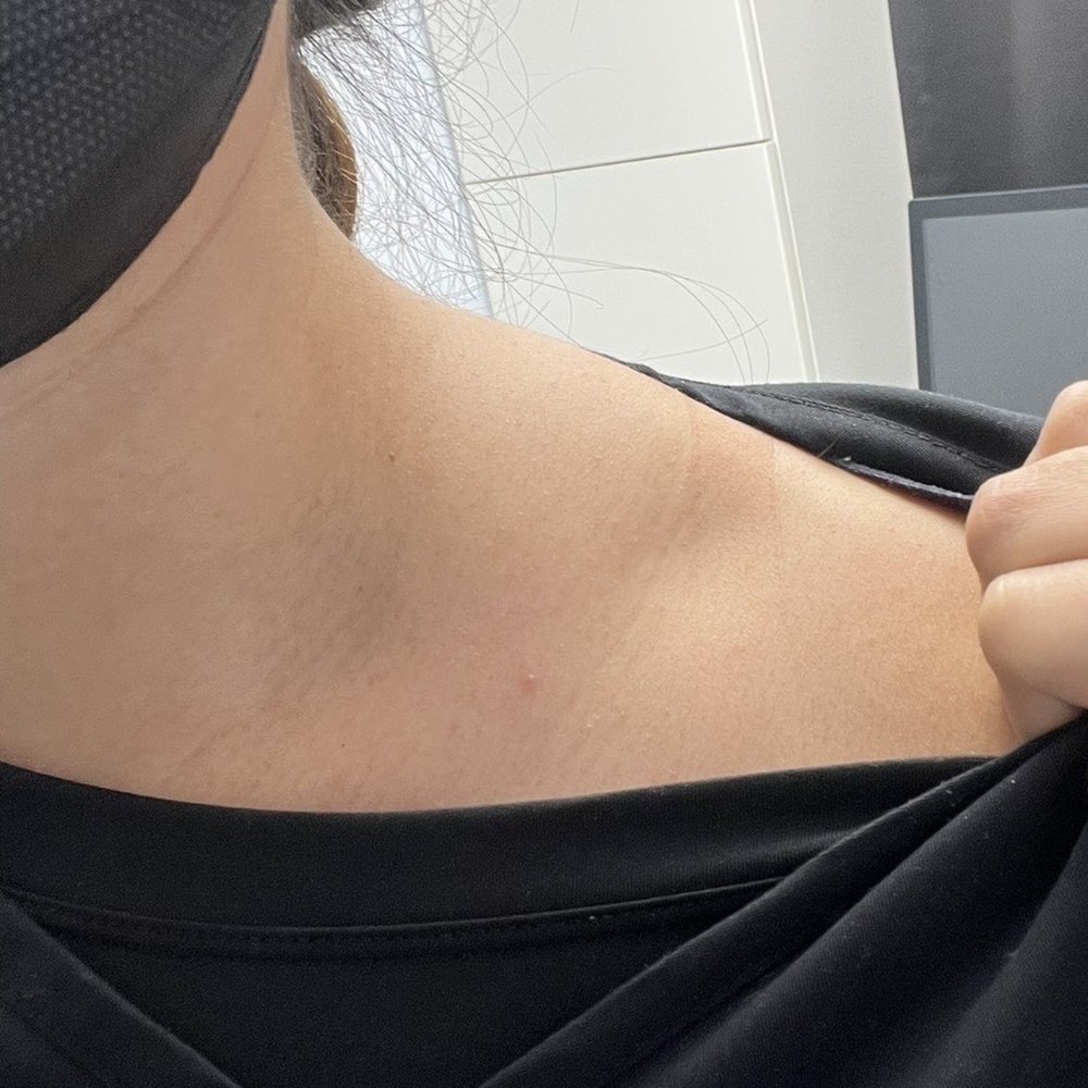 My trap prior to seeing Dr. Baker My trap prior to seeing Dr. Baker